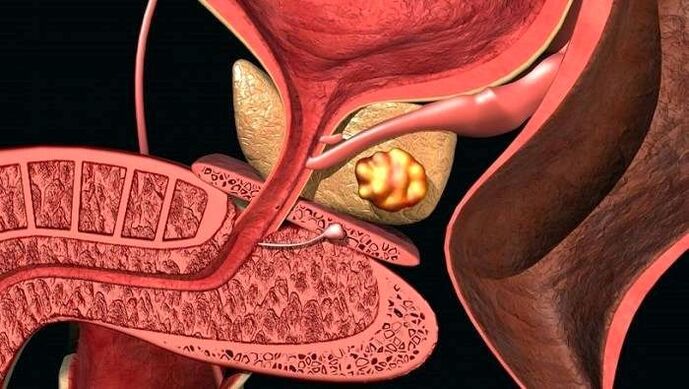 Stone deposition in the prostate with cumulative prostatitis