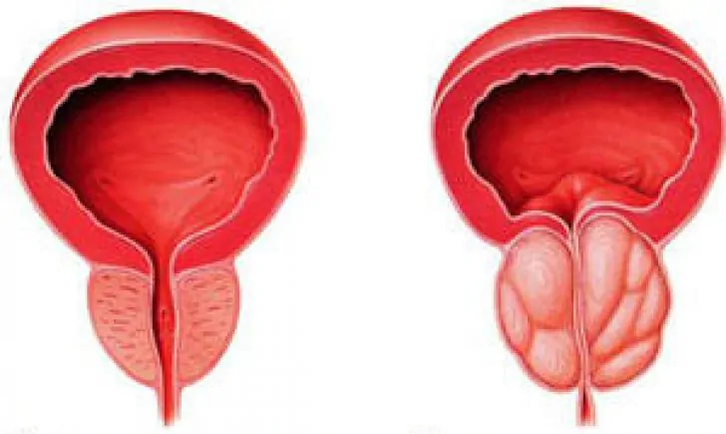 Normal prostate (left) and inflammatory chronic prostatitis (right)